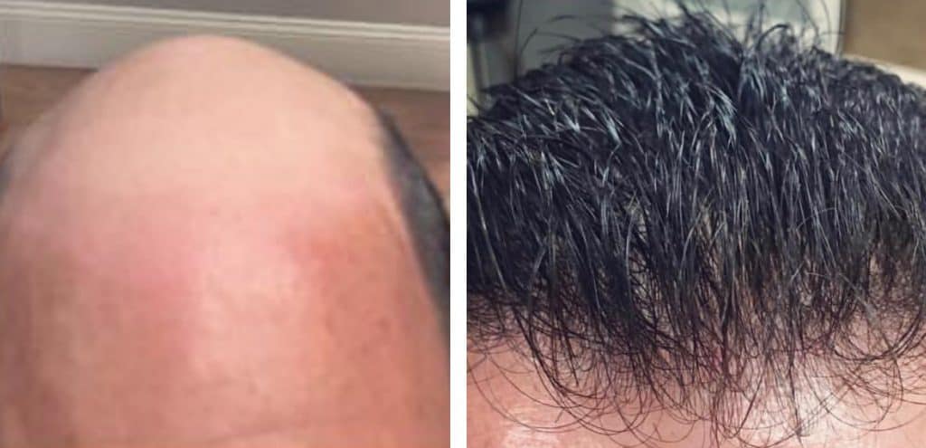 Before & After Pictures of men suffering from Men's hair loss and the other one after treatment