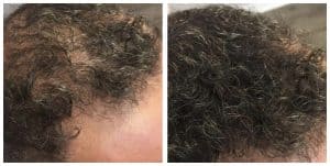 Side by side picture of before and after treatment of a man suffering from Balding and the other after treatment 