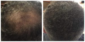 Side by side picture of before and after treatment of a man suffering from Balding and the other after treatment with more hair